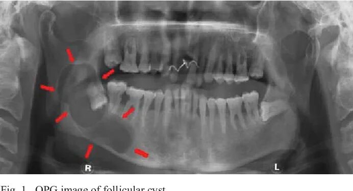 Киста на небе фото PDF Classification of jawbone cysts via orthopantomogram processing Semantic Sch