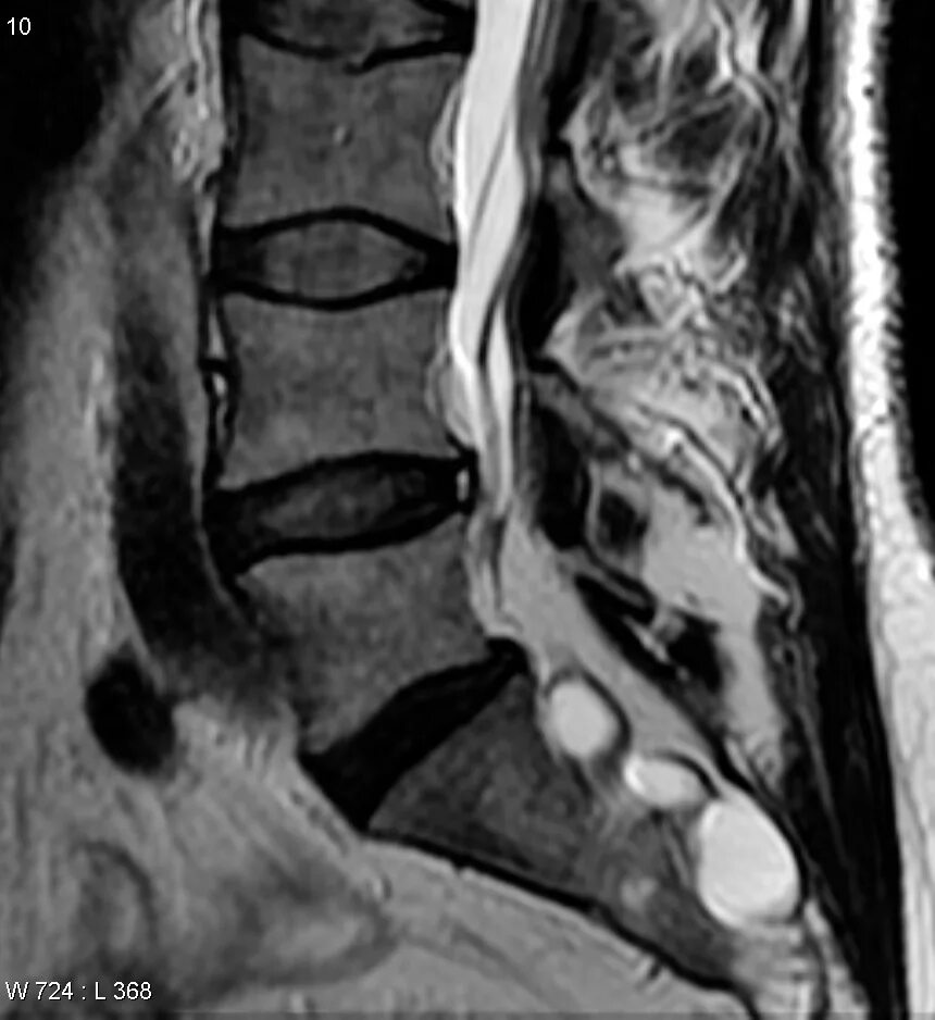 Киста на позвоночнике в поясничном отделе фото Annular fissure Image Radiopaedia.org