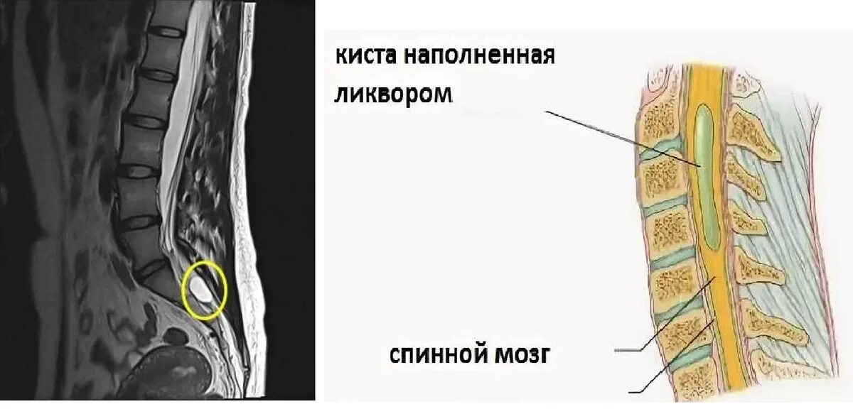 Киста на позвоночнике в поясничном отделе фото Киста позвоночника. Чем опасна и как вовремя избавиться? Evolutis Clinic Дзен