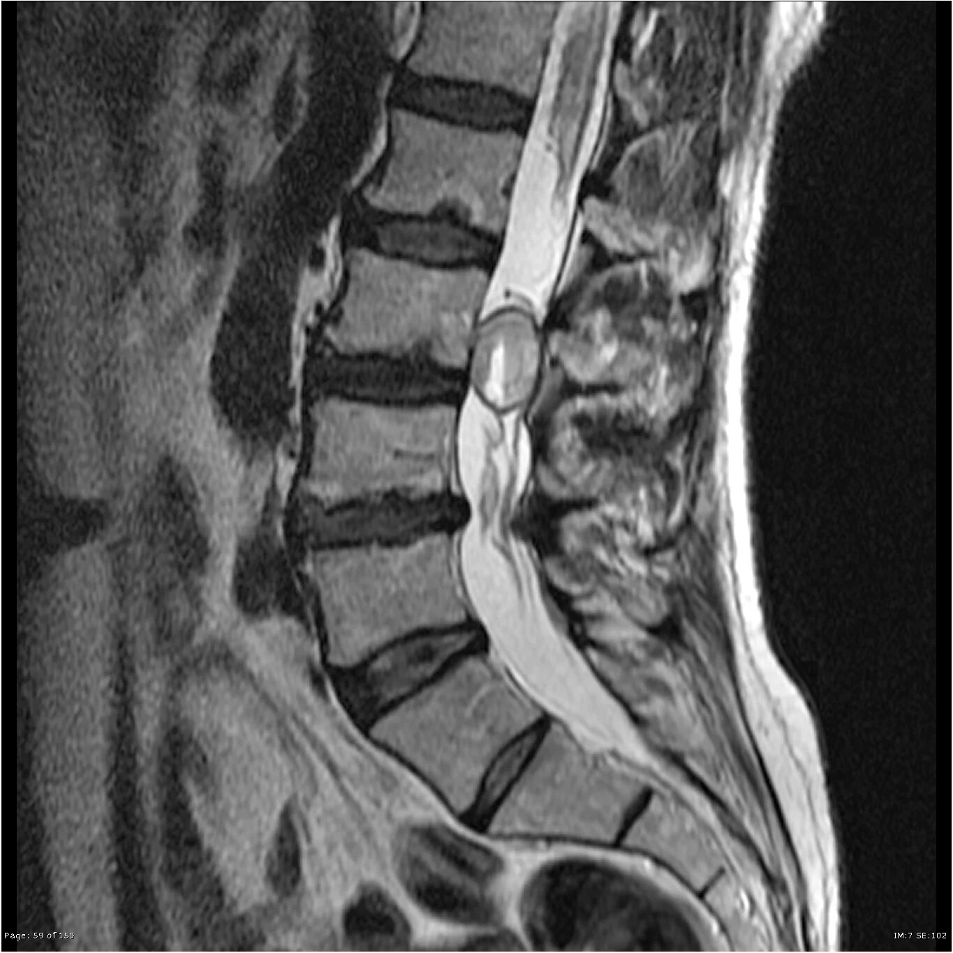 Киста на позвоночнике в поясничном отделе фото Cauda equina neuroendocrine tumor Image Radiopaedia.org