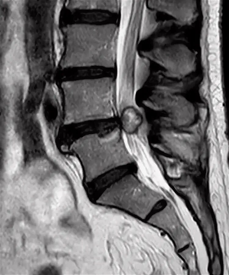 Киста на позвоночнике в поясничном отделе фото Spinal Cysts - Avicenna Clinic