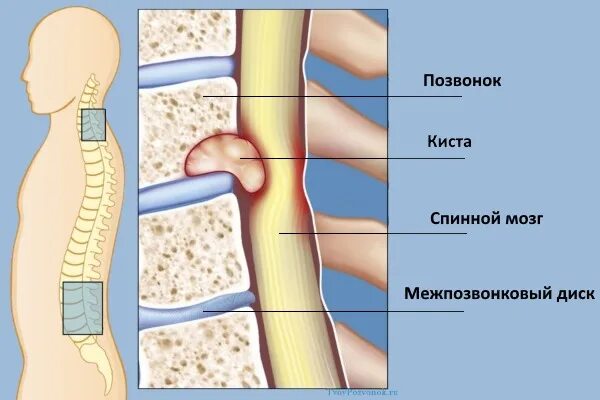 Киста на позвоночнике в поясничном отделе фото Киста позвоночника пояснично-крестцового, шейного отдела: причины возникновения,