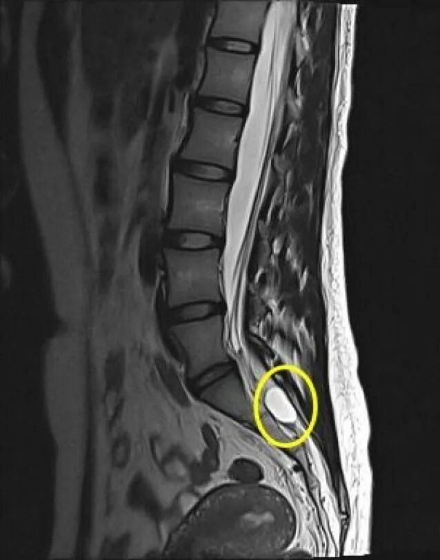 Киста на позвоночнике в поясничном отделе фото Pin on Lower Back Pain