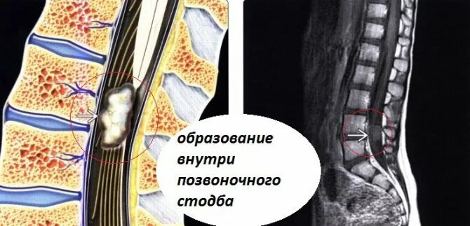 Киста на позвоночнике в поясничном отделе фото Операция по удалению кисты на позвоночнике