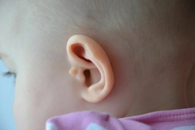 Киста на ухе у ребенка фото Добавочные козелки на ушках - Вопросы о детях - BabyPlan.ru