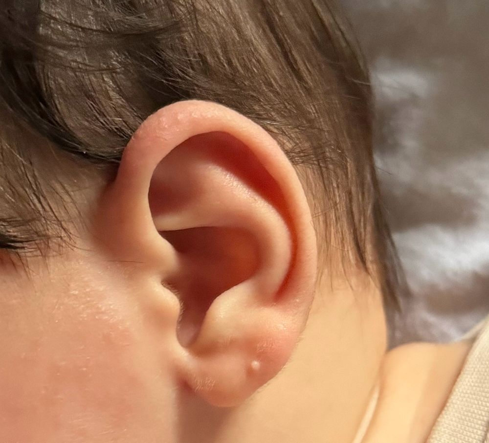 Киста на ухе у ребенка фото Образование на ушке у ребенка 4 мес - 10 ответов форум Babyblog