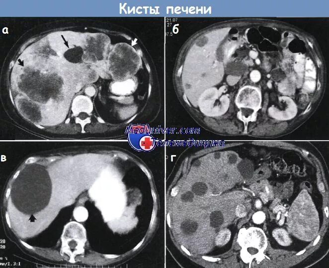 Киста печени фото Кисты печени - диагностика