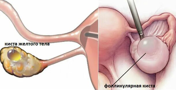 Киста симптомы фото Функциональная киста яичника - причины, симптомы, лечение, операция. - Хирург К.