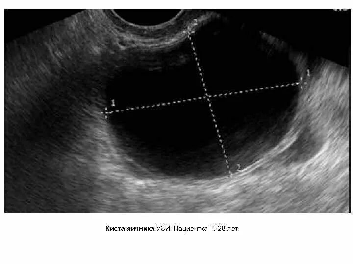 Киста симптомы фото Функциональная киста правого яичника: фото и успешное лечение
