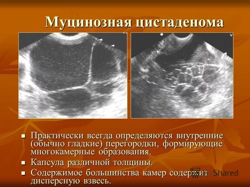 Киста симптомы фото Доброкачественные и злокачественные опухоли матки - найдено 87 картинок