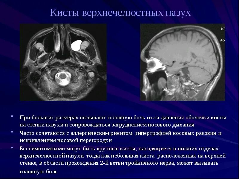 Киста симптомы фото МАГНИТО-РЕЗОНАНСНАЯ ТОМОГРАФИЯ в исследовании околоносовых пазух