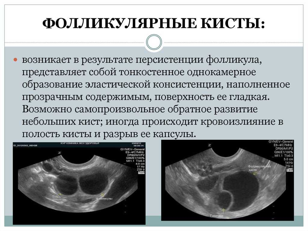 Киста симптомы фото А она может лопнуть или разорваться? Киста яичника - полный гид по патологии О з