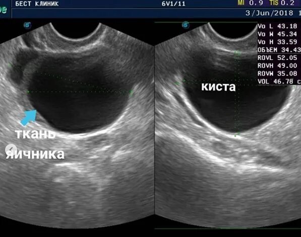 Киста симптомы фото Функциональная киста правого яичника: фото и успешное лечение