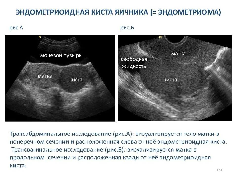 Киста симптомы фото Кисты яичника - что такое и чем опасны при беременности