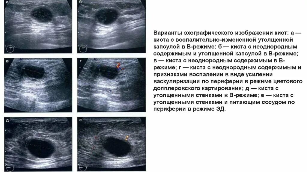 Киста симптомы фото Киста в молочной железе образуется: найдено 90 изображений