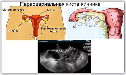 Киста симптомы фото Функциональная киста яичников: нужна ли операция?