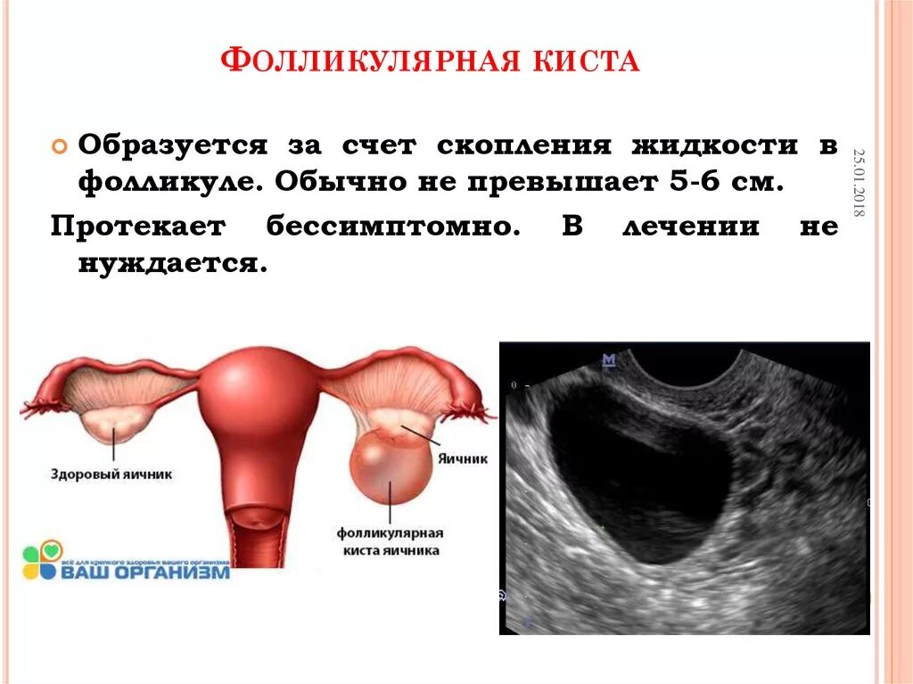 Киста симптомы фото Киста яичника что это значит