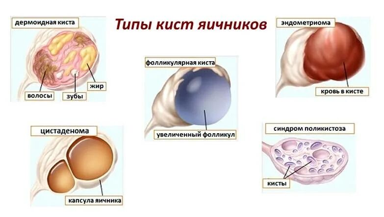 Киста симптомы фото Киста правого яичника - симптомы, лечение, операция. - Хирург К. В. Пучков