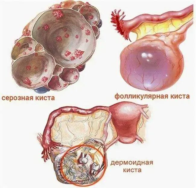 Киста симптомы фото А она может лопнуть или разорваться? Киста яичника - полный гид по патологии О з