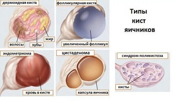 Киста симптомы фото Лечение и удаление кисты яичников в Севастополе: цены на операцию клиника "Бонус