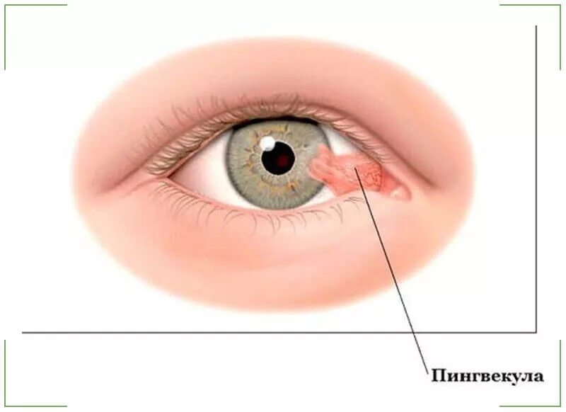 Киста в глазу фото Пингвекула глаза: симптомы, причины и методы лечения - "Здоровое око"