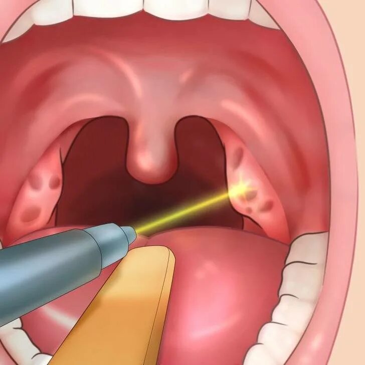 Киста в горле фото Воспалилось небо - что делать?(Причины и лечение)
