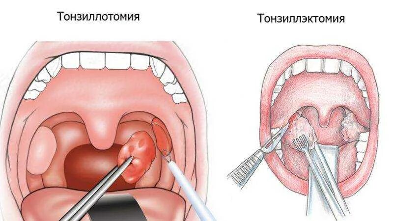 Киста в горле фото Удаление пробок из миндалин