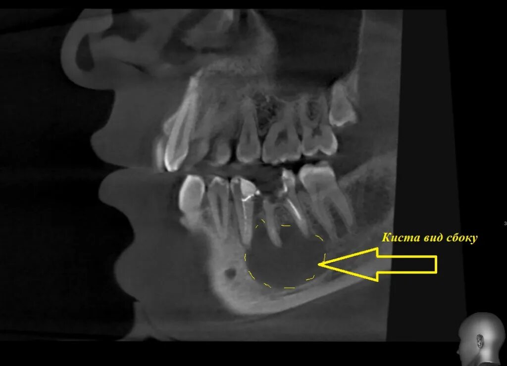 Киста верхней челюсти фото Киста зуба: что такое, ее симптомы, способы лечение, причины возникновения
