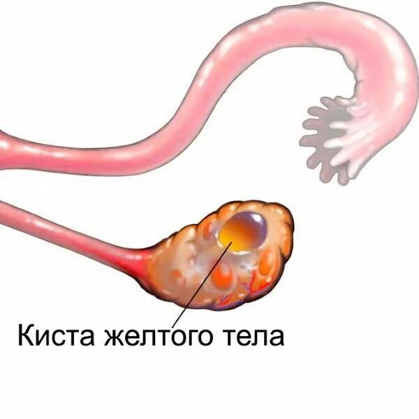 Киста желтого тела фото Желтое тело у коров: что это такое, причины, как лечить