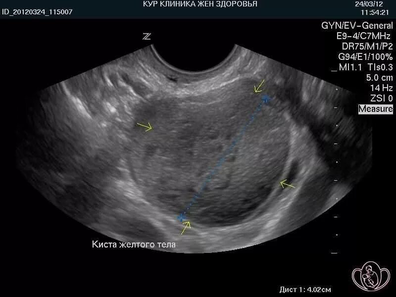 Киста желтого тела фото Желтое тело при узи что это - найдено 72 картинок
