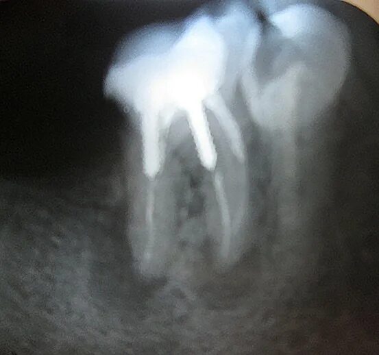 Киста зуба фото рентген Что делать с зубом (кисты)? - Вопрос стоматологу - 03 Онлайн