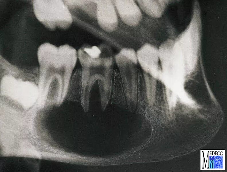 Киста зуба фото рентген Radikuläre Zysten