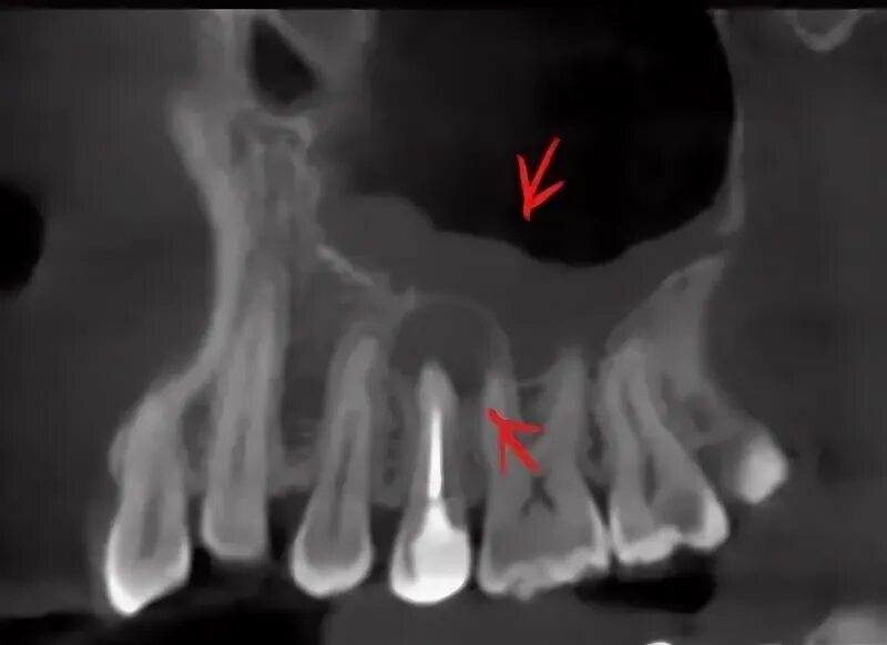Киста зуба фото рентген Что и почему может болеть в "мертвом" зубе? / Стоматологический центр "Мичуринск