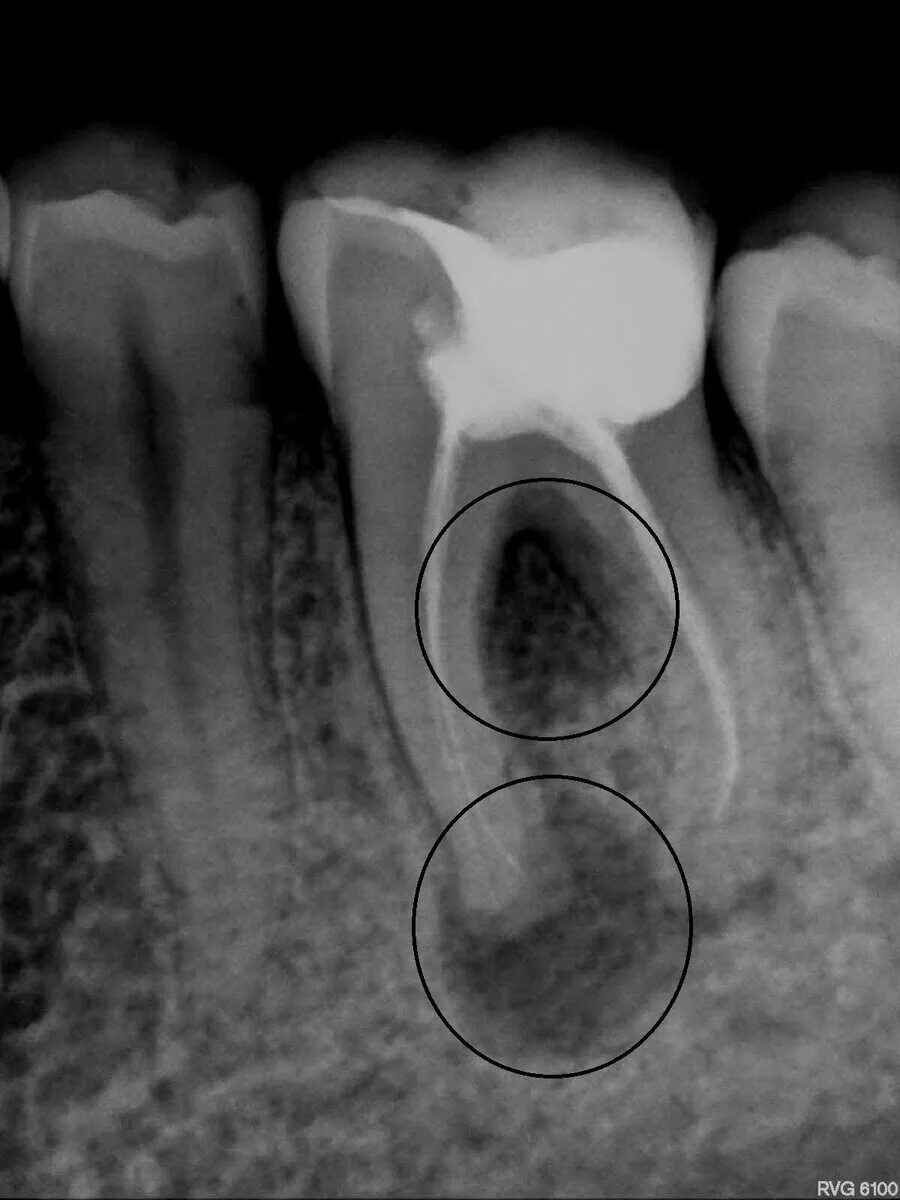 Киста зуба фото рентген Киста зуба - осложнения и лечение Клиника стоматологии МАРТ Дзен