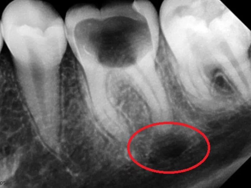 Киста зуба фото рентген Лечение кисты зуба