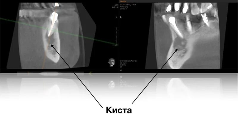 Киста зуба фото рентген Лечение кисты зуба без удаления - цена от 7450 руб, симптомы и методы лечения ки