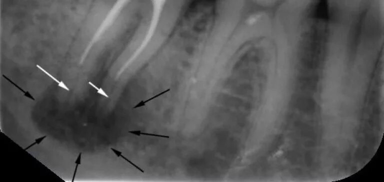 Киста зуба фото рентген Лечение кисты зуба в Москве, цены и методы лечения без удаления