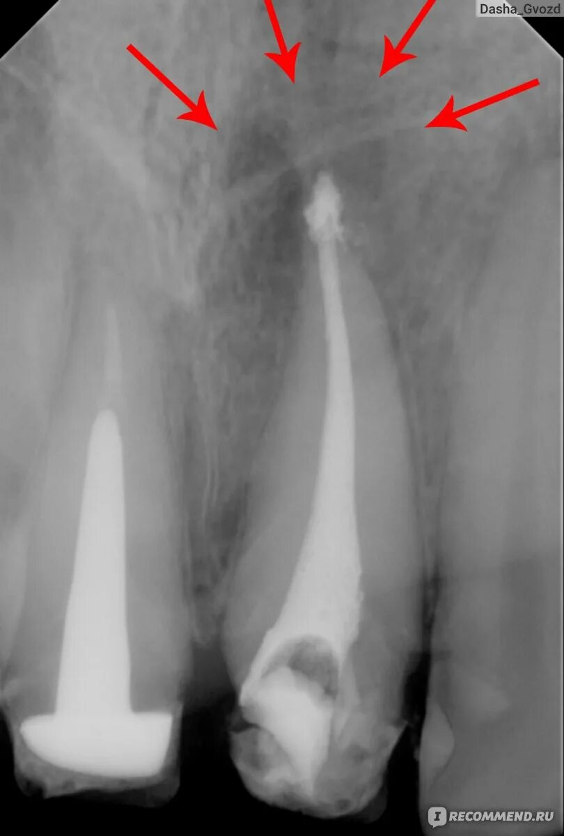 Киста зуба фото рентген Лечение кисты зуба у стоматолога - "Как благодаря криворукому стоматологу я чуть