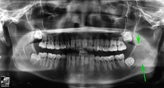 Киста зуба мудрости фото Челюстная киста: симптомы и виды Радикулярная киста, аневризмальная киста и друг