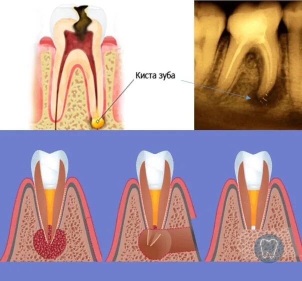 Киста зуба реальные фото A tooth cyst is a pathological formation that is a cavity that occurs inside the