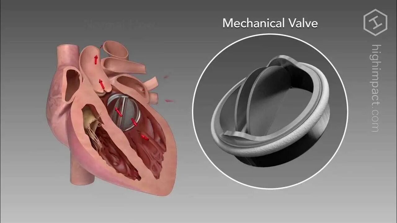 Клапаны сердца фото Heart Valve Replacement Options - YouTube