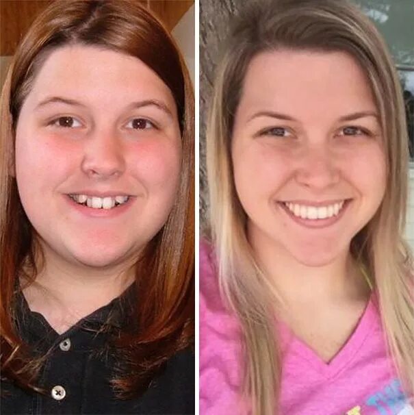 Класс до и после фото 114 Incredible Before & After Transformations Of People Who Wore Braces After br