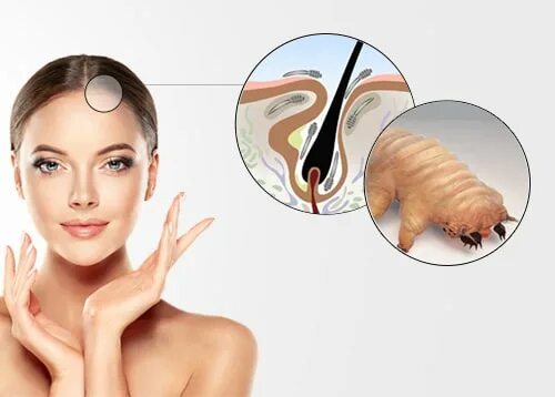 Клещ демодекс на голове фото Notes Ungex - Demodex Hair Mites Removal Solution Articles