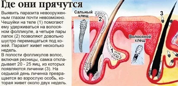 Клещ демодекс на голове фото Azelaic acid. Drugs that act on the skin, the instruction for use in cosmetics