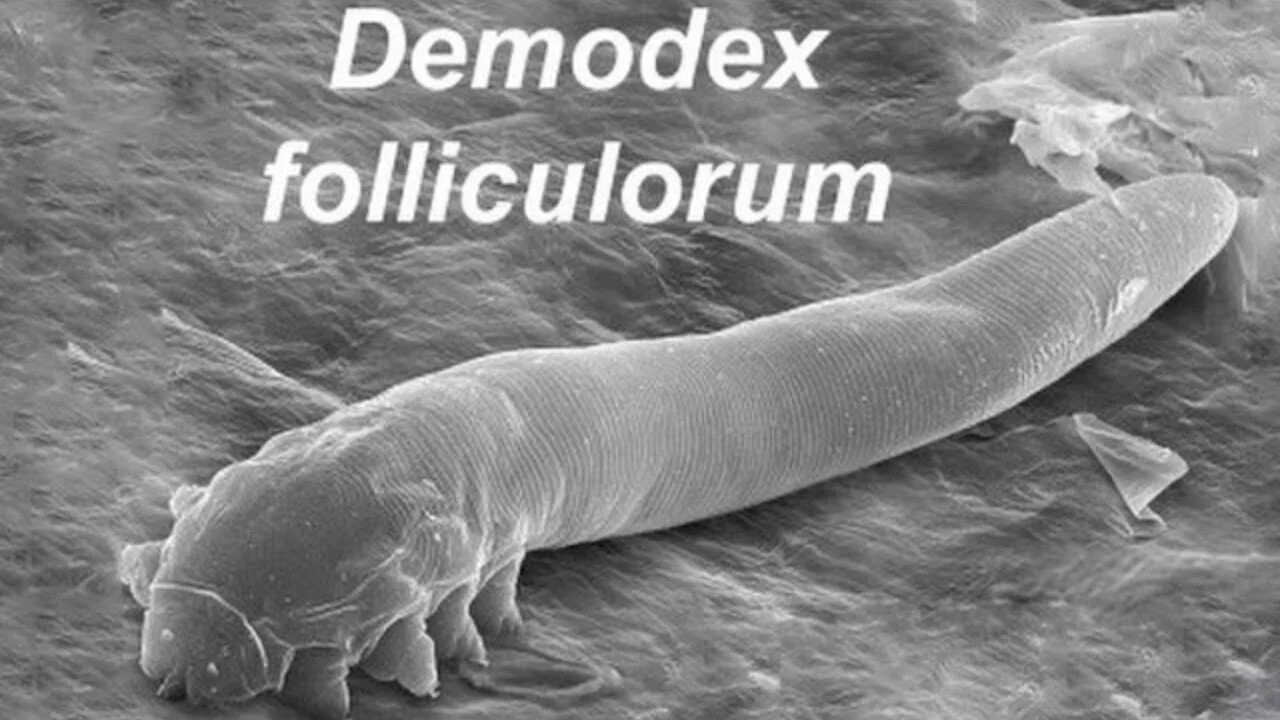 Клещ демодекс на голове фото Demodex Folliculorum Железница Угревая - Морфология, Жизненный цикл, Профилактик