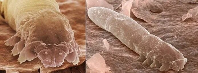 Клещ демодекс на голове фото Demodex folliculorum