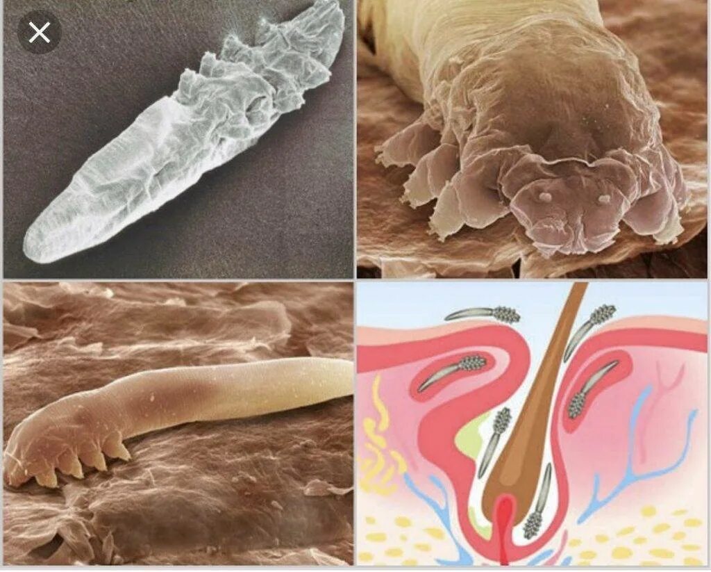 Клещ демодекс на голове фото Клещ Демодекс: симптомы и лечение кожи лица