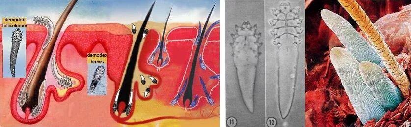Клещ демодекс на голове фото Демодекоз - лечение и симптомы, причины появления