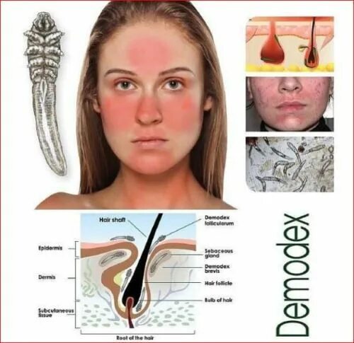 Клещ демодекс на голове фото Pin by Ungex on Ungex Demodex treatment, Demodex, Skin