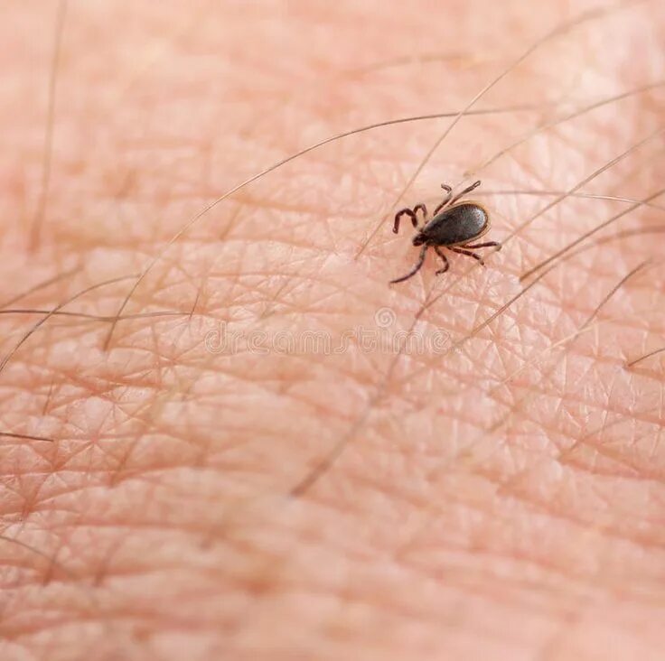 Клещ фото плоский Tick. Deer Tick (Ixodes scapularis) on human skin , #Aff, #Ixodes, #Deer, #Tick,